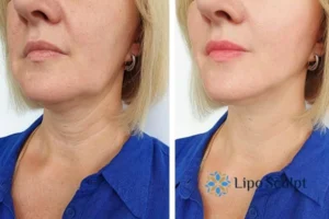 Double chin before and after Hi-Fu treatment 4 Book your double chin treatment Birchills today! We are here to help!