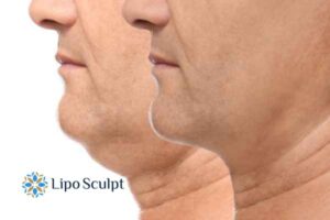 Double chin before and after Hi-Fu treatment 2 Double chin treatment Birchills from Lipo Sculpt - feel more confident today!