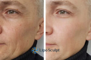 How to Fight Aging Symptoms 3 Fight Aging Symptoms Birchills With HIFU and Morpheus8 Today!