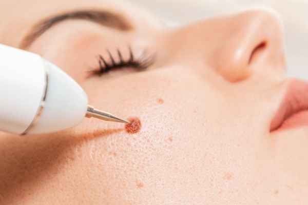 CryoPen: 5 Skin Concerns It May Be Used to Treat 3 What actually happens during a CryoPen treatment Birchills?