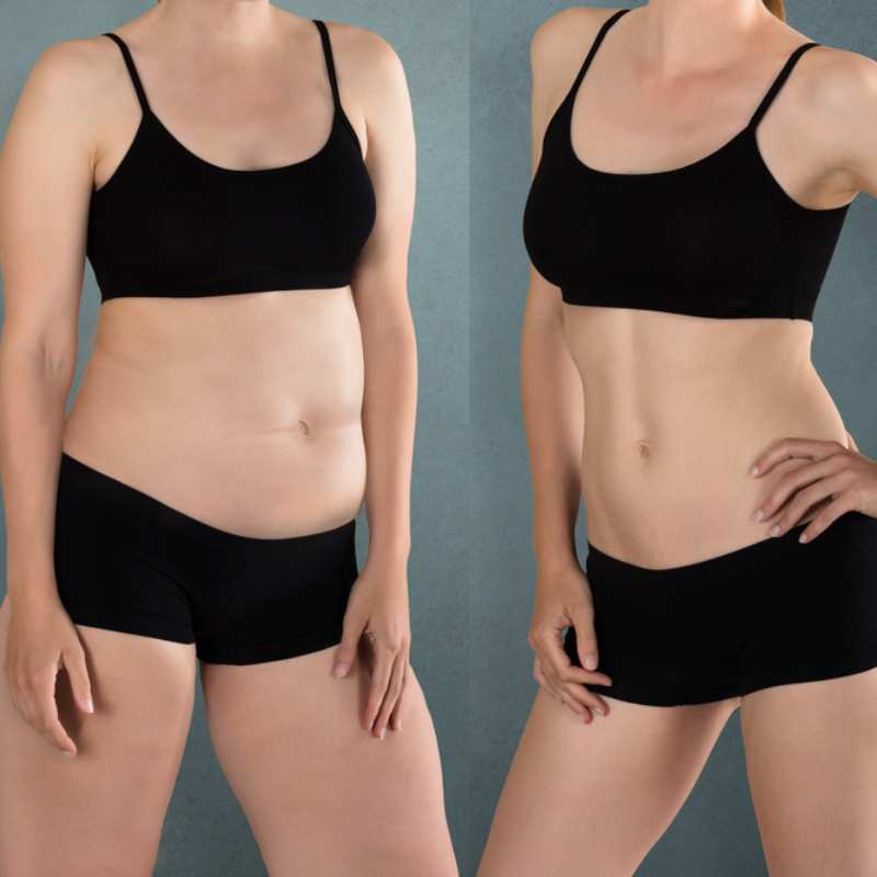 Does Fat Freezing at Home Work? DIY Devices vs Professional Cryolipolysis 2 before and after Cryolipolysis Birchills