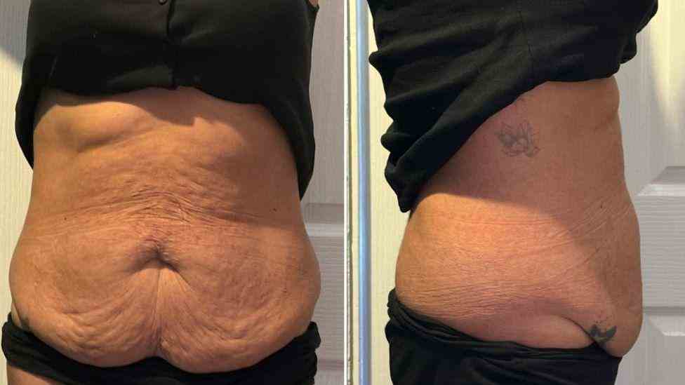 Lost the Weight but Not the Loose Skin? What You Should Know 1 Is It Definitely Loose Skin Birchills?